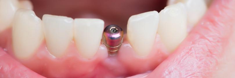 Implantat ohne Zahnkrone