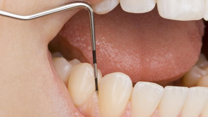 Zahnfleischtransplantation vorher nachher